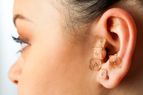 acupunture in the ear